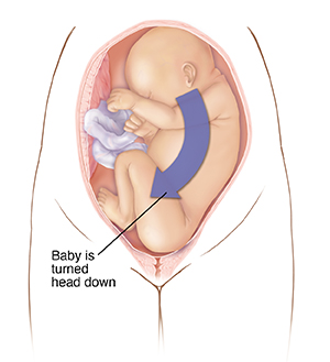 Front view of baby in uterus in head-up position. Arrow shows baby to be turned to head-down position for childbirth.