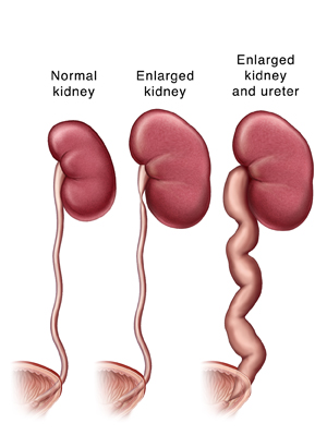 Normal kidney and ureter, enlarged kidney, and enlarged kidney and ureter.