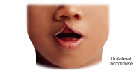 Illustration of a unilateral incomplete cleft lip