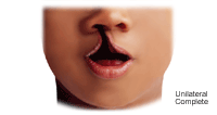 Illustration of a unilateral complete cleft lip