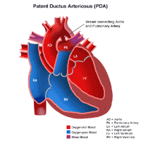 Anatomy of a heart with a patent ductus arteriosus