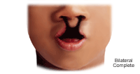 Illustration of a bilateral complete cleft lip