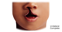Click Image to Enlarge Illustration of a unilateral complete cleft lip