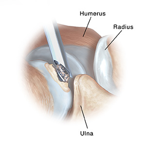 Side view of elbow joint showing burr removing bone spur.
