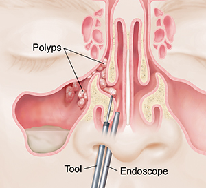Closeup of instruments inserted in nose, removing polyps.