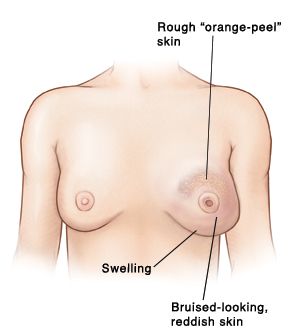 Front view of woman's chest showing swelling, rough orange-peel skin, and bruised-looking, reddish skin on left breast. Left breast has inverted nipple. Right breast is normal.