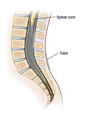 Side view cross section of lower spine showing spinal cord and spinal nerves in spinal canal. Catheter is inserted in skin between two vertebrae and into spinal canal. Catheter does not go into sac surrounding spinal nerves.