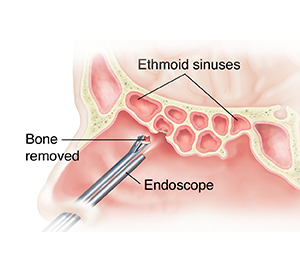 Side view of inside of nose showing instruments removing bone from ethmoid sinus.